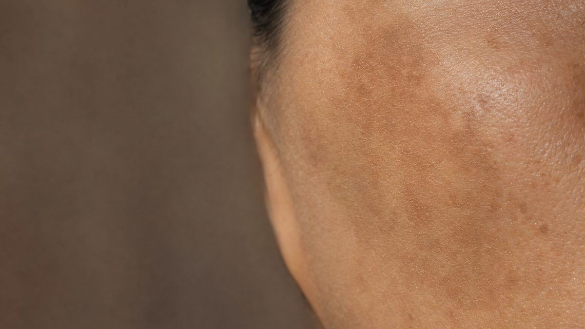 Close-up of a woman's cheek showing patchy brown pigmentation