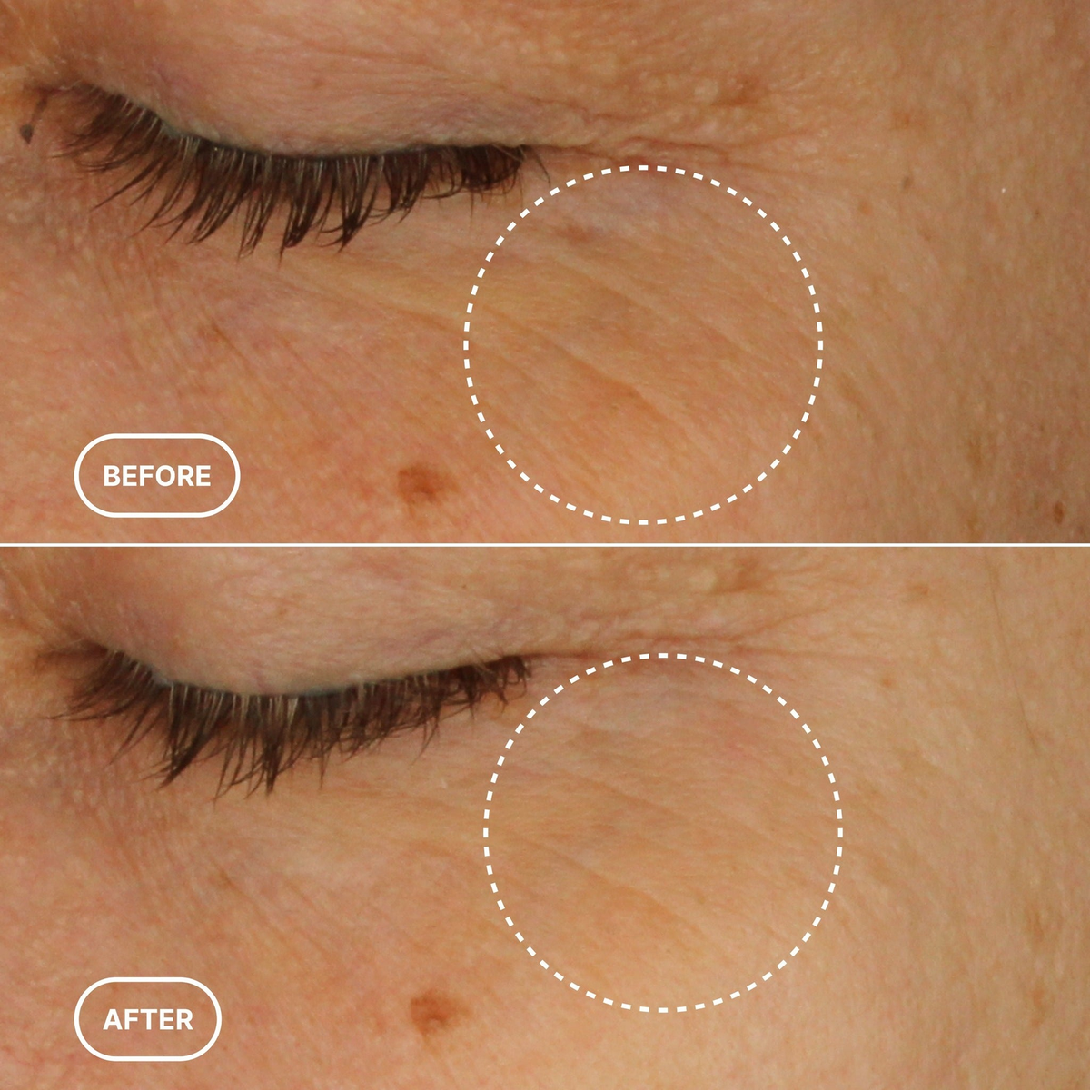 Before and after close-up of the eye area on skin, showing the outer eye and under-eye region