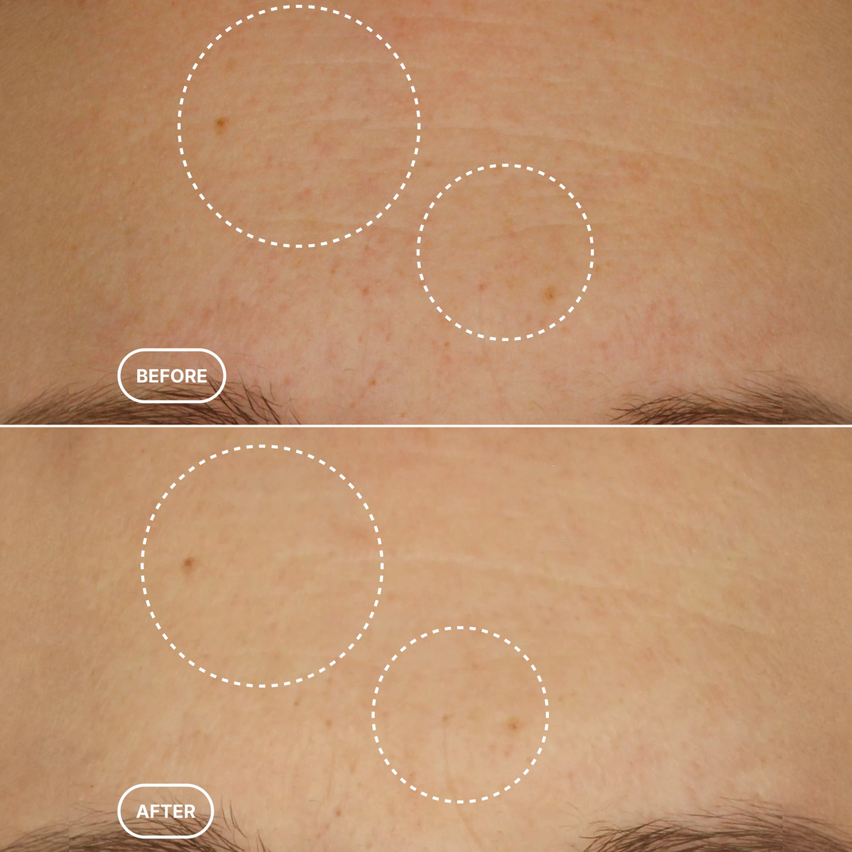 Before and after close-up of the forehead area