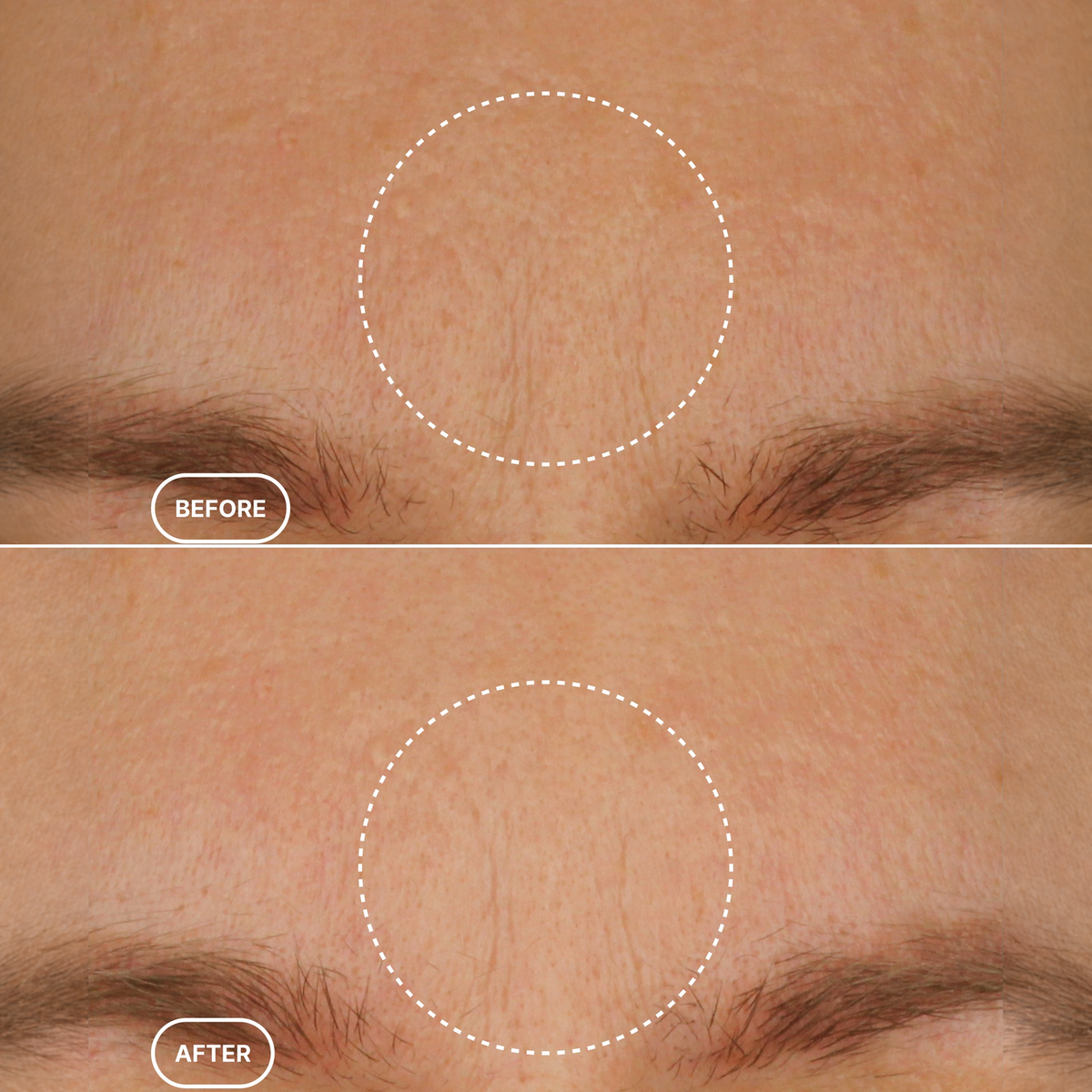 Before and after close-up of the forehead area